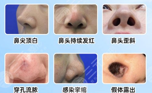 隆鼻