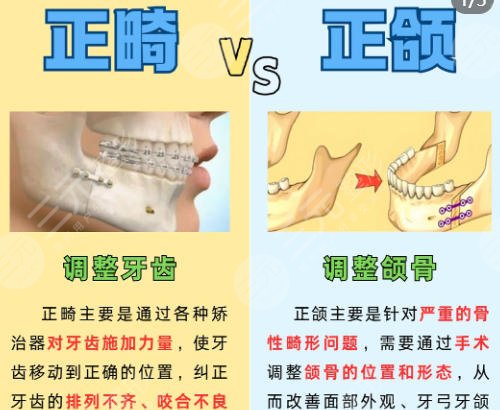 正颌手术