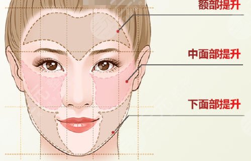 面部提升