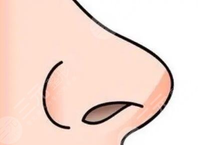 隆鼻