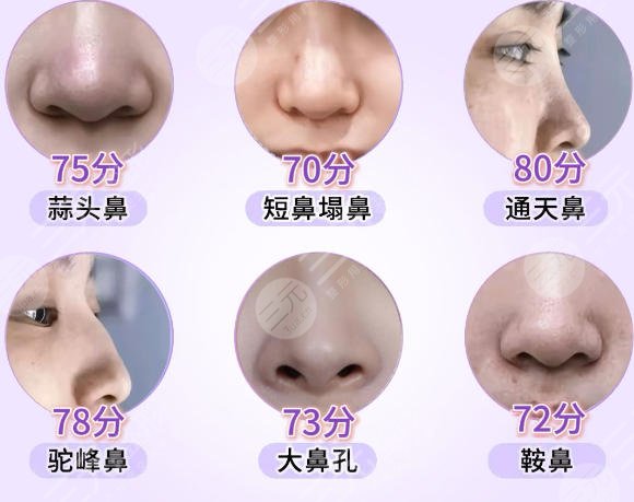 隆鼻
