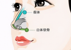 石河子大学附属医院隆鼻多少钱？假体隆鼻贵不贵，术前检查到手术费用如何组成