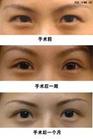<b>双眼皮整形前应知道的事情</b> <b>双眼皮整形前应知道的事情</b>