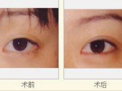 重睑(双眼皮)整形说明 重睑(双眼皮)整形说明