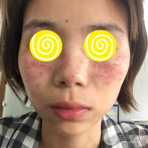激光祛斑三天后的照片和几天结痂脱落过程案例