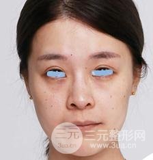 浙江省中医院整形美容科殷莉波自体脂肪填充案例