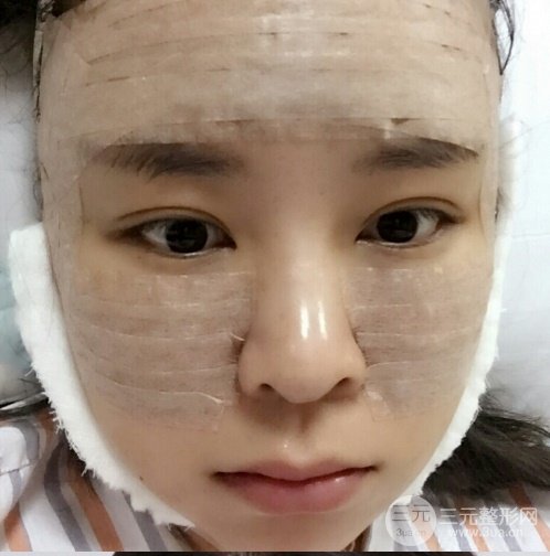 浙江省中医院整形美容科殷莉波自体脂肪填充案例