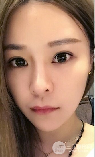 浙江省中医院整形美容科殷莉波自体脂肪填充案例
