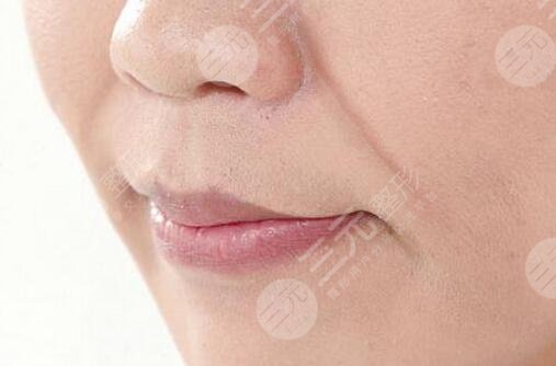 玻尿酸丰鼻唇沟更深了是真的吗？真实案例果告诉你答案！