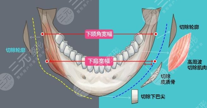 下颌角切除费用一般多少钱？下颌角切除手术优势是什么？