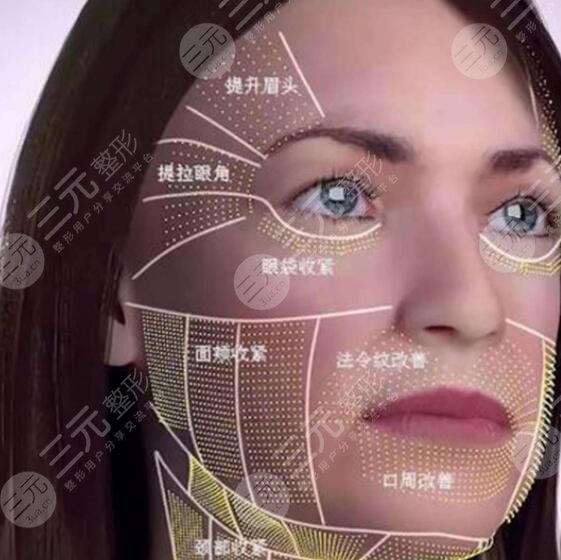 电波拉皮的功与作用，共有4个吸引人的作用，都是哪些呢？