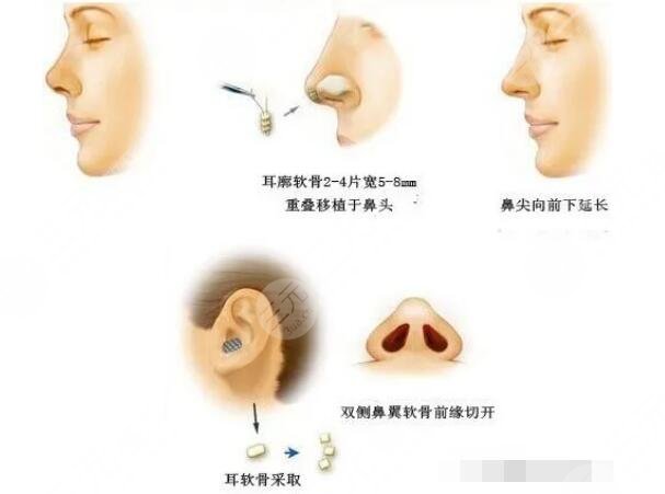 耳软骨鼻会被全部吸收吗？耳软骨隆鼻的优点及注意事项解析~