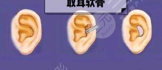耳软骨鼻子可以维持多久？耳软骨隆鼻的恢复时间和注意事项解读
