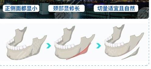 韦敏做磨骨手术怎么样,价格贵不贵 韦敏做磨骨手术怎么样,价格贵不贵
