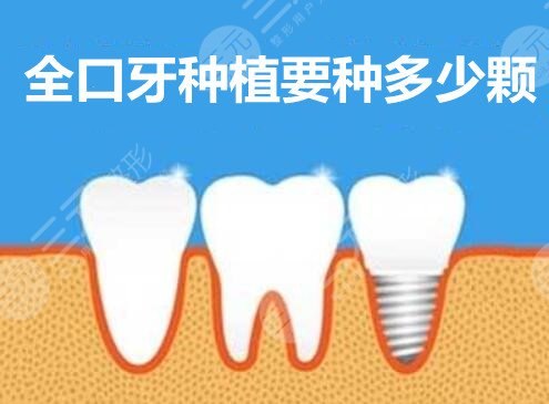 全口牙种植要种多少颗？全口牙种植要多少钱？注意事项有哪些？