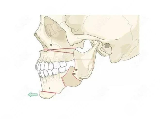 颧骨整形适合哪些人 颧骨整形手术前后对比图