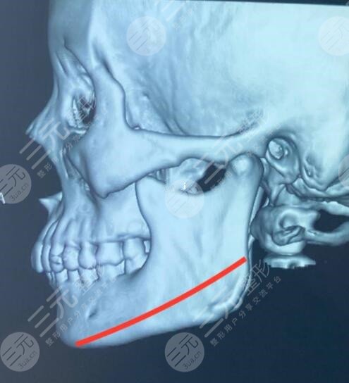 磨骨手术价位高吗？超全讲解项目知识，来学习咯！