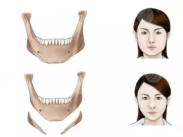 下颌角整形手术流程：真实的小V脸手术是怎样的?