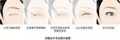 割双眼皮的方法有哪些 双眼皮手术方法