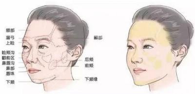 关于脂肪填充那些事儿，为什么要做脂肪填充?