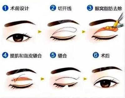 做完全切双眼皮多久可以种睫毛？多久能恢复自然？