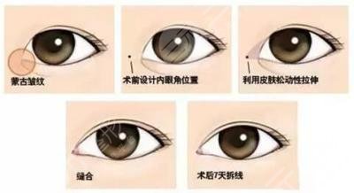 开眼角好吓人哦！是真的吗？注意事项有哪些？