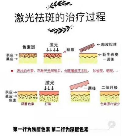 答疑|超激光pm祛斑要做几次才能去除干净？果维持多久？“斑”花变班花~