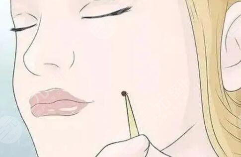 祛痣后10天恢复图片：真人展示10天的恢复果~