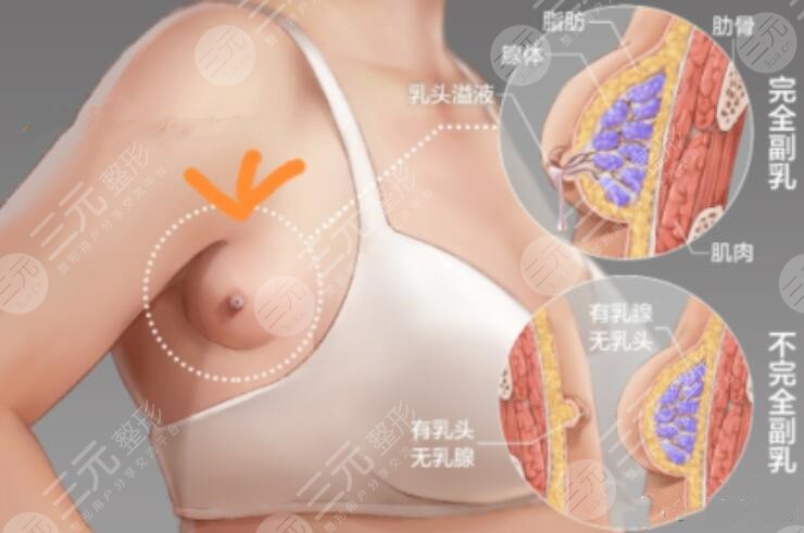 切除副乳对比图片，真人展示切除副乳术后1个月，她说没了副乳后终于敢秀身材了~
