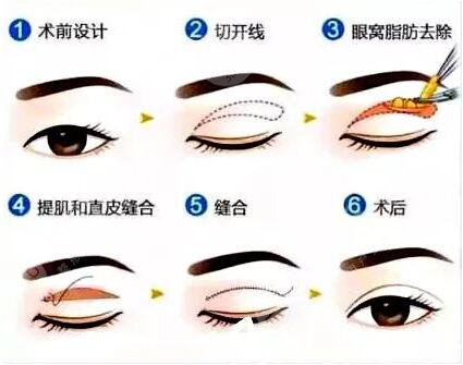 专家介绍双眼皮手术方法