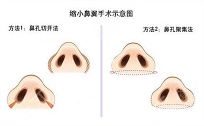 鼻头缩小术有哪些方法 鼻头缩小术有哪些方法