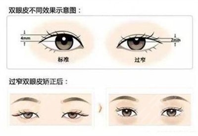 双眼皮手术有没有副作用呢