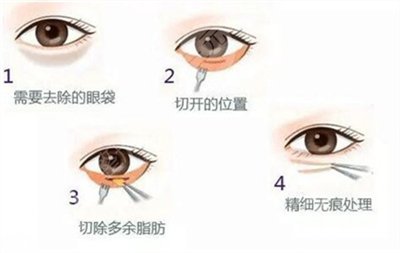 去眼袋那种方法果好