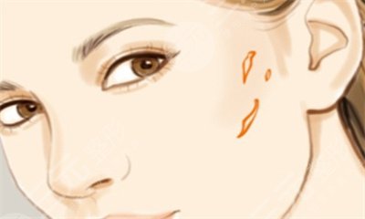 什么是疤痕体质 疤痕体质可以做整形吗 什么是疤痕体质 疤痕体质可以做整形吗