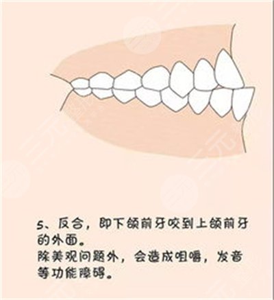 北京地包天矫正价格是多少 北京地包天矫正价格是多少