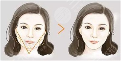 改脸型后遗症有哪些 改脸型后遗症有哪些