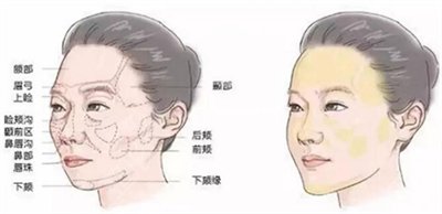 自体脂肪丰苹果肌能维持多久 自体脂肪丰苹果肌能维持多久