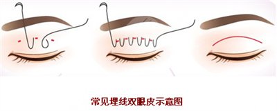割双眼皮后会变形吗 割双眼皮后会变形吗