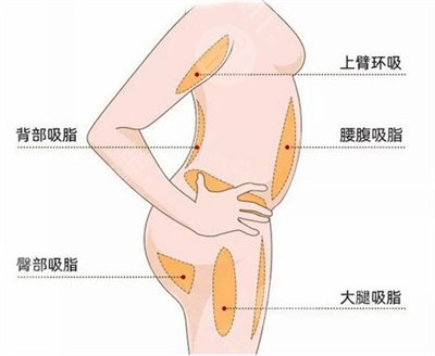 抽脂多少钱？全身抽脂多少钱？