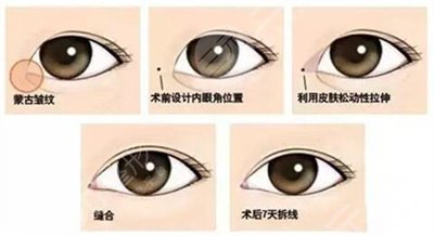 开眼角手术前后对比图