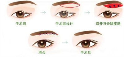 上睑下垂多少钱?上睑下垂需要去脂吗? 上睑下垂多少钱?上睑下垂需要去脂吗?