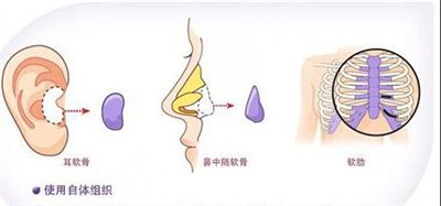 自体脂肪丰耳垂的优点有哪些? 自体脂肪丰耳垂的优点有哪些?