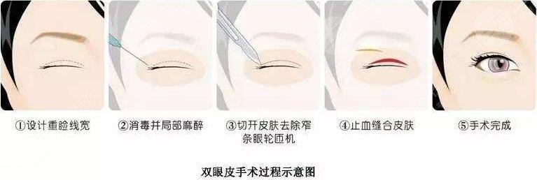 眼部综合整形的注意事项有哪些
