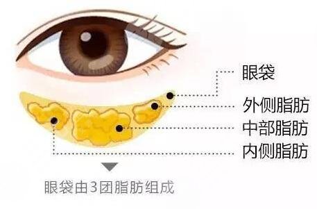 眼袋是怎样形成的 简单有的去眼袋方法有哪些