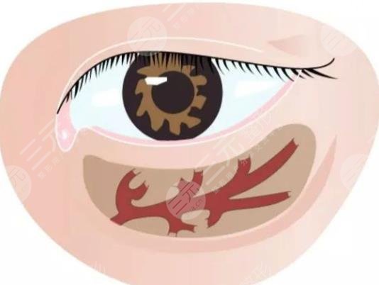 激光去黑眼圈多少钱 激光去黑眼圈的缓解果好不好 激光去黑眼圈多少钱 激光去黑眼圈的缓解果好不好