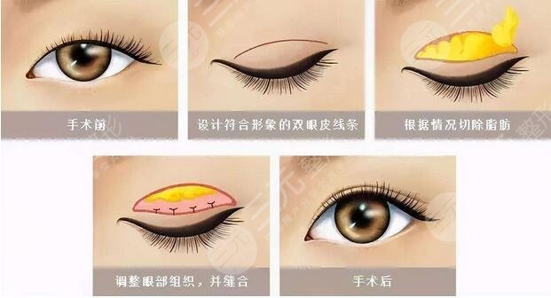 5个你要注意的双眼皮手术后遗症