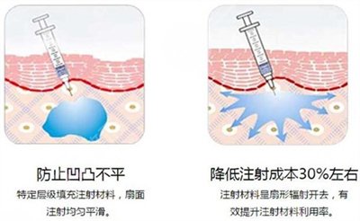 玻尿酸丰太阳穴能维持多久 玻尿酸丰太阳穴果如何 玻尿酸丰太阳穴能维持多久 玻尿酸丰太阳穴果如何