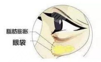 嗨体填充泪沟好不好?原理_副作用_注意事项超全盘点! 嗨体填充泪沟好不好?原理_副作用_注意事项超全盘点!