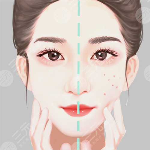 光子嫩肤的功与作用深层解答！看看做几次有果~