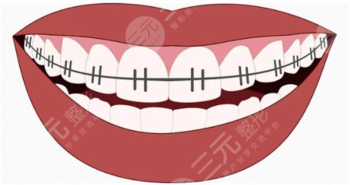 美容冠矫正龅牙过程是怎样的?美容冠矫正龅牙详解~ 美容冠矫正龅牙过程是怎样的?美容冠矫正龅牙详解~